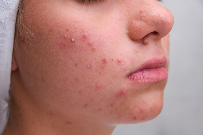 Active Acne,active acne treatment,active acne meaning
