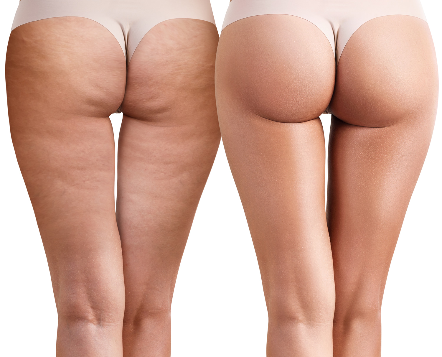 Cellulite,cellulite treatment,cellulite treatment istanbul,cellulite causes