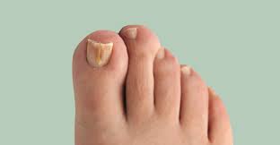 Nail Fungus Care,nail fungus cure,nail fungus treatment at home,nail fungus treatment near me