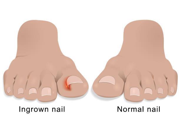 Ingrown toenails,ingrown toenails treatment,ingrown toenails removal,ingrown toenails videos