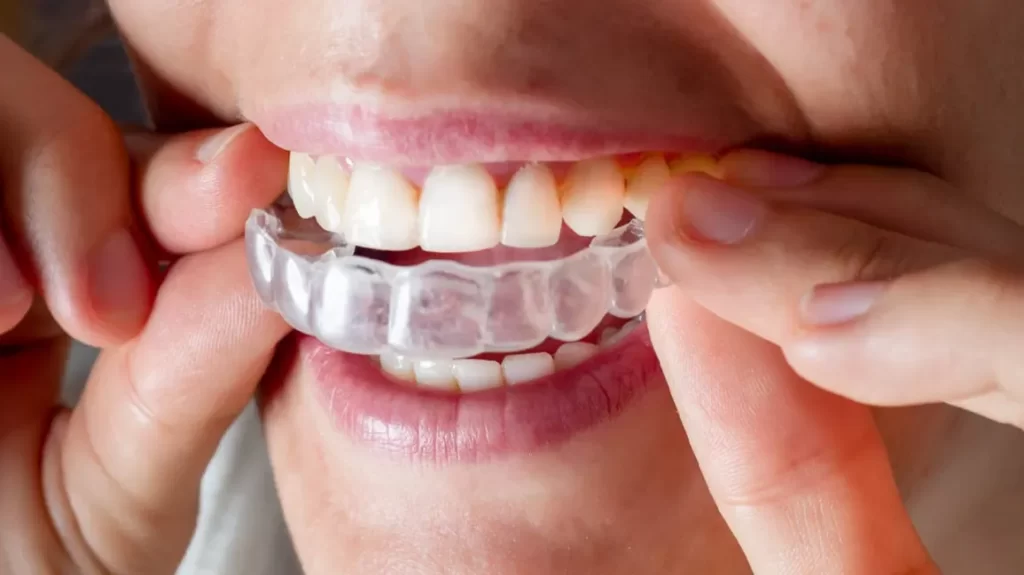 Invisalign,invisalign fiyat,invisalign nedir,invisalign doctor site
