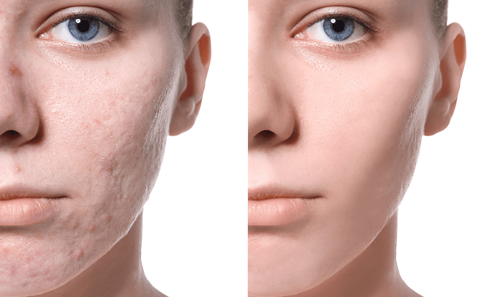Skin Resurfacing,skin resurfacing treatment,skin resurfacing cost,skin resurfacing laser