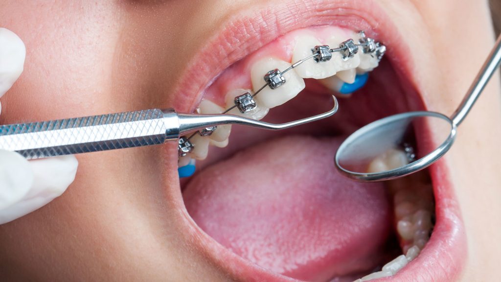 Orthodontic,orthodontic treatment,orthodontics meaning
