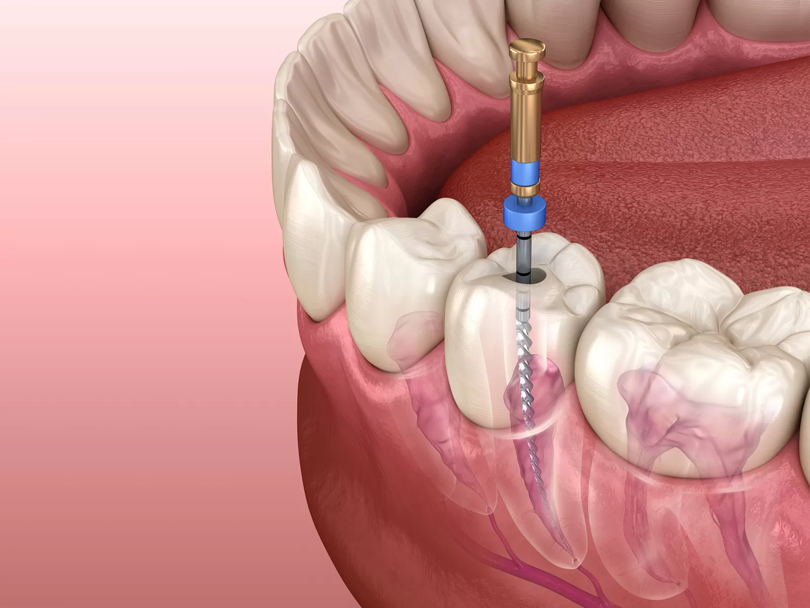 Root Canal,root canal treatment,root canal treatment cost