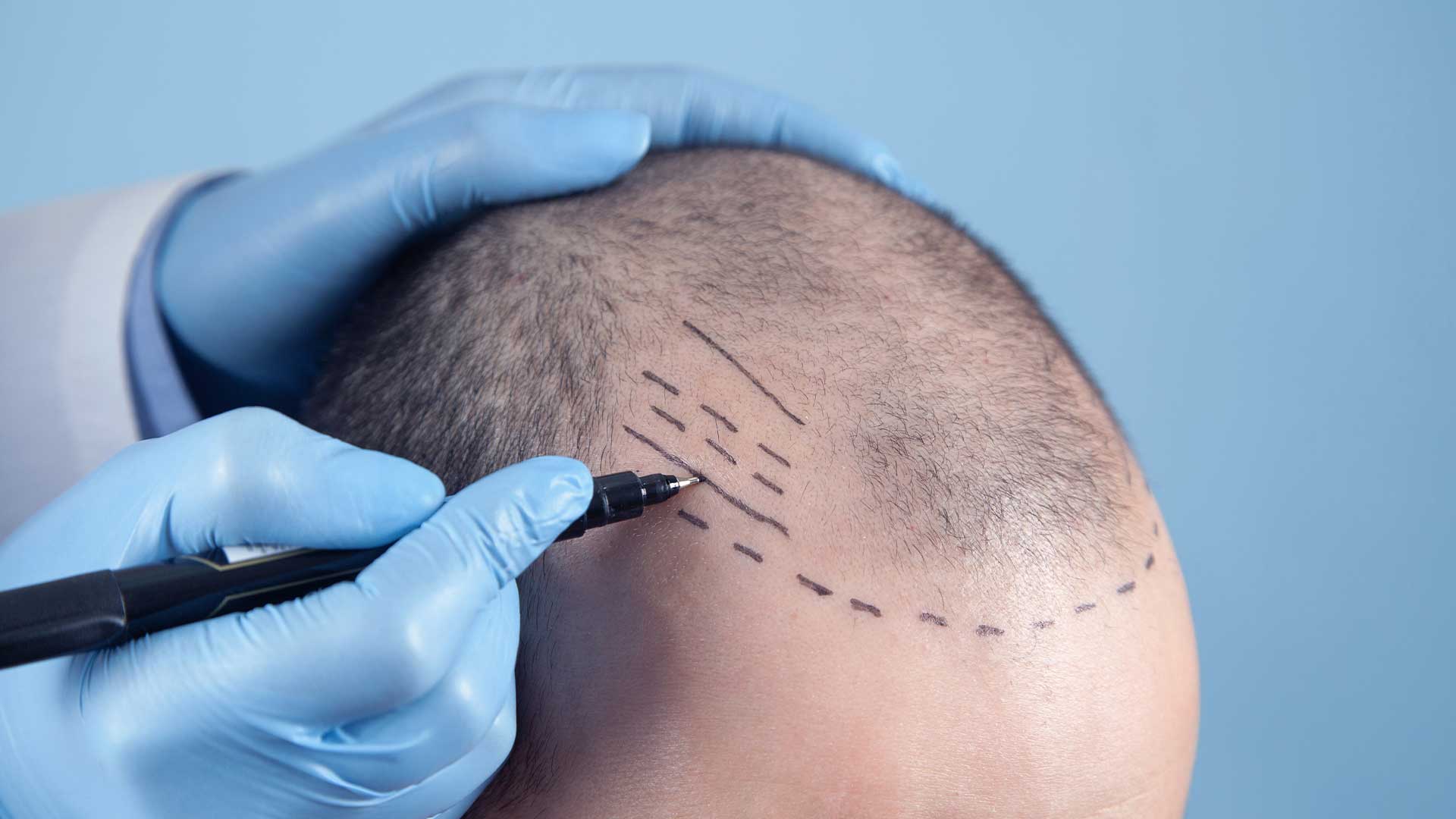 Hair Transplant,hair transplant istanbul,hair transplant turkey,hair transplant before and after,hair transplant antalya,hair transplant turkey cost,hair transplant aftercare,hair transplant ankara